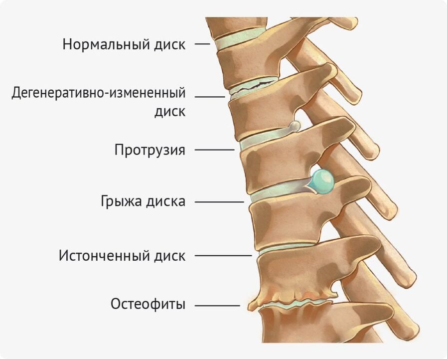 Disko deformacijos juosmens osteochondrozei