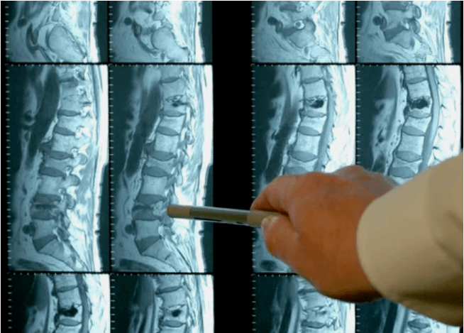 Osteochondrozės veislės stuburo