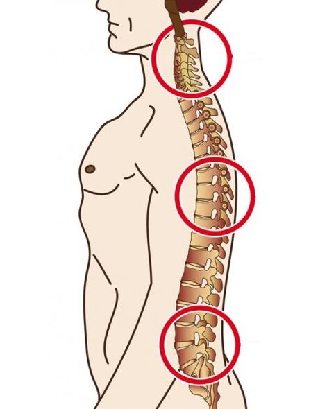 stuburo skyriai, kuriuose atsiranda osteochondrozė