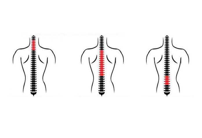 Kaip pasireiškia osteochondrozė
