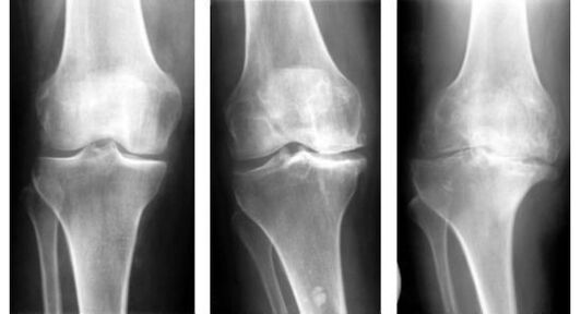 Privaloma diagnostinė priemonė nustatant kelio sąnario artrozę yra rentgeno nuotrauka